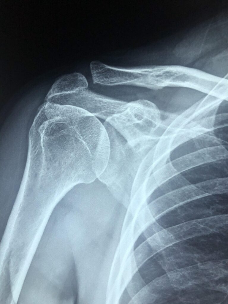 Risk Factors for Poor Outcomes After Shoulder Dislocation Surgery