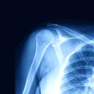 shoulder surgeon new york