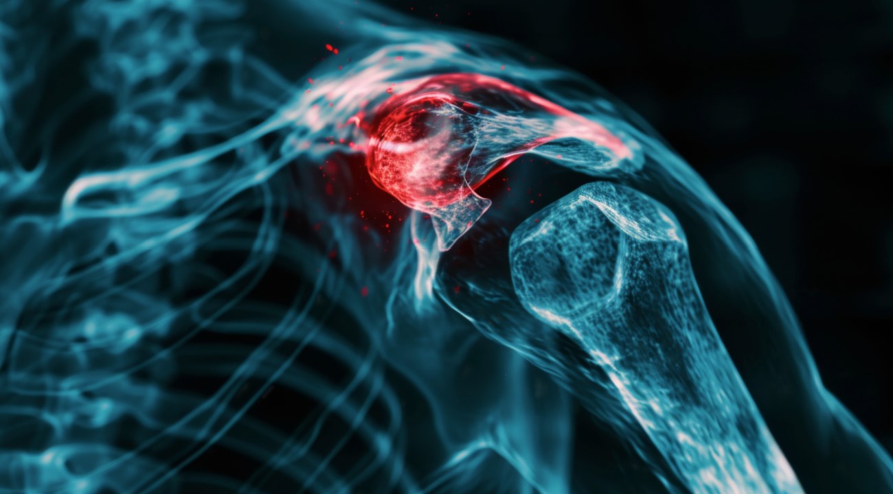When It Comes to Shoulder Pain, One Size Doesn’t Fit All [Video]