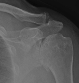 bone spurs in the shoulder on the acromion