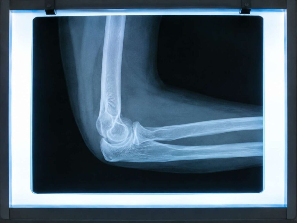X-ray image showing an elbow fracture