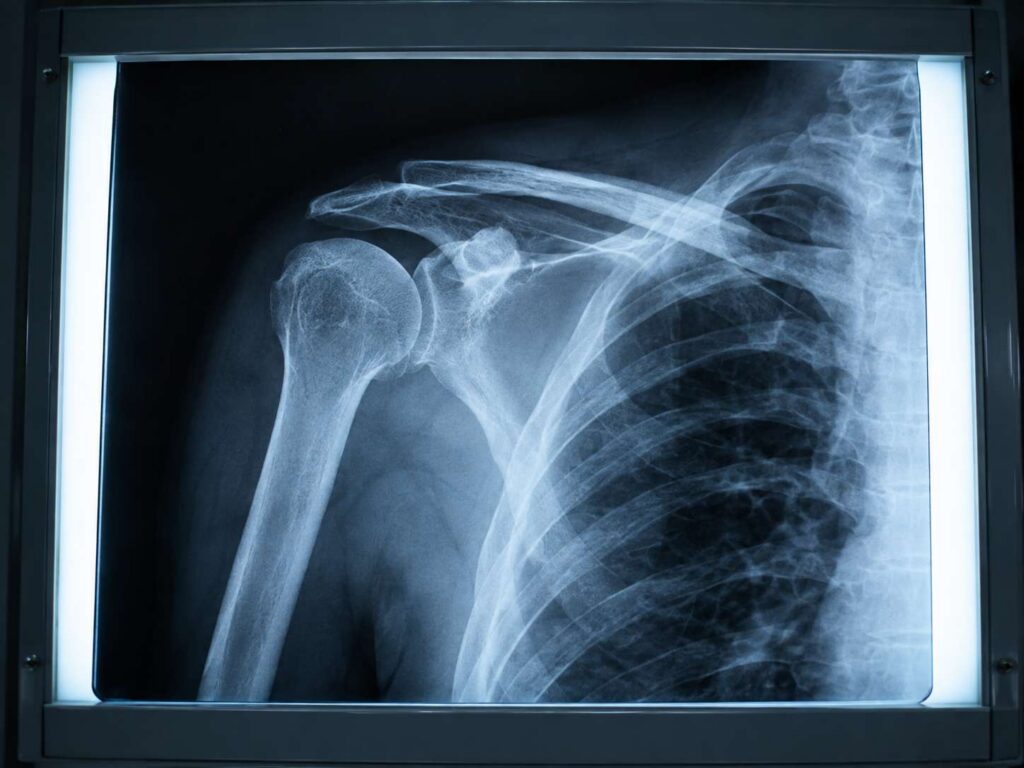 X-ray image showing a shoulder fracture